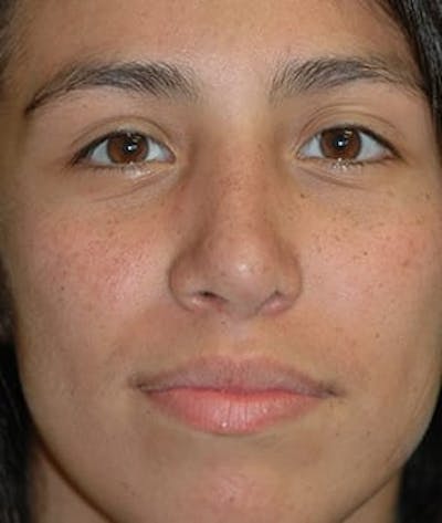 Rhinoplasty Before & After Gallery - Patient 410628 - Image 2