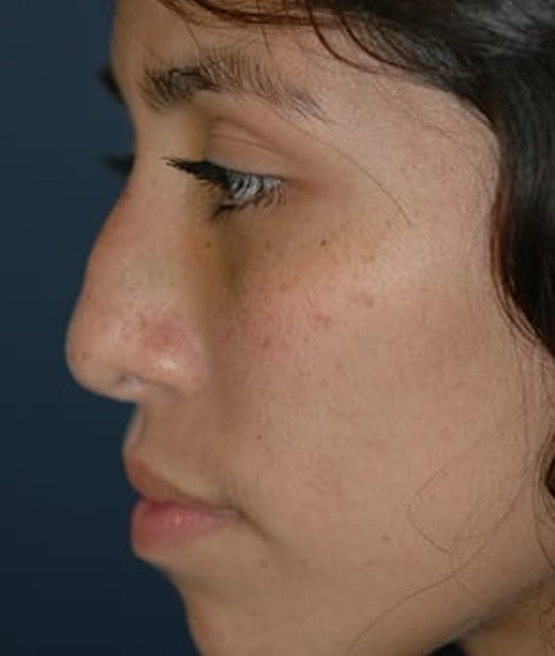 Rhinoplasty Before & After Gallery - Patient 410628 - Image 3