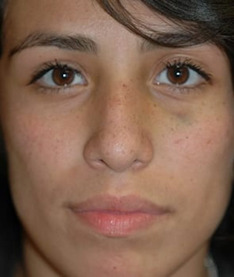 Rhinoplasty Before & After Gallery - Patient 410628 - Image 1