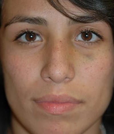 Rhinoplasty Before & After Gallery - Patient 410628 - Image 1