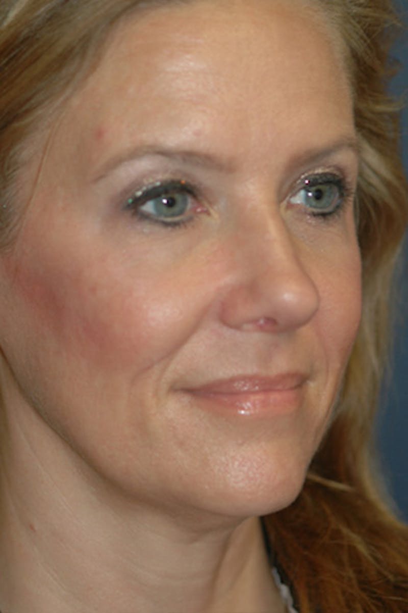 Rhinoplasty Before & After Gallery - Patient 175561 - Image 4
