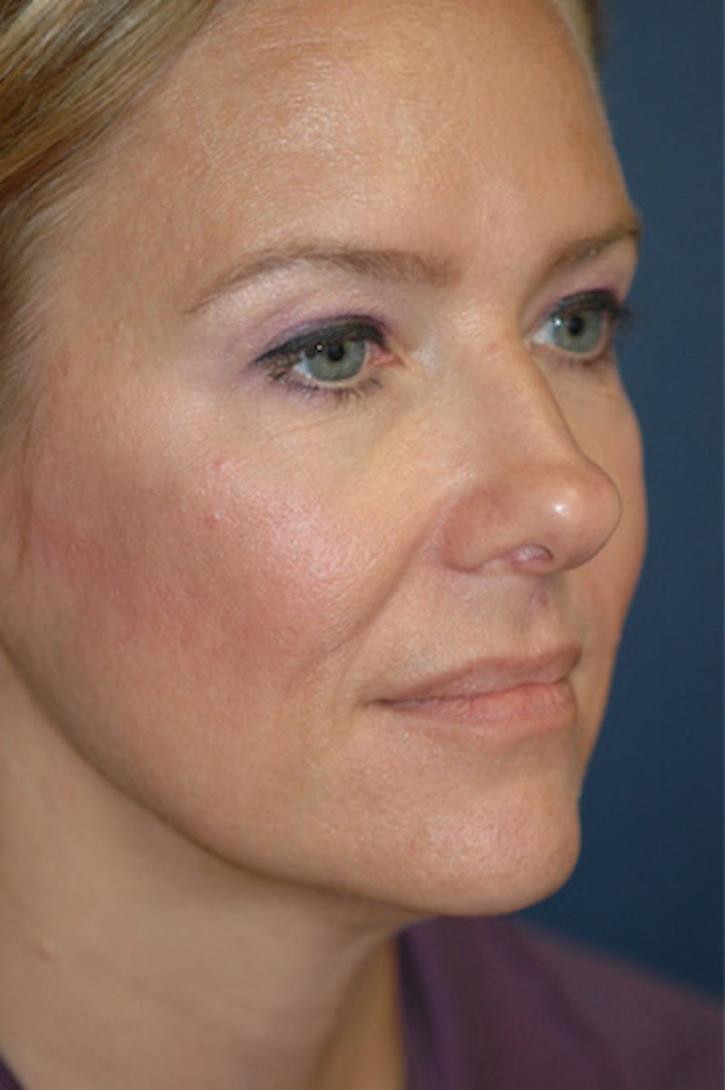 Rhinoplasty Before & After Gallery - Patient 175561 - Image 3