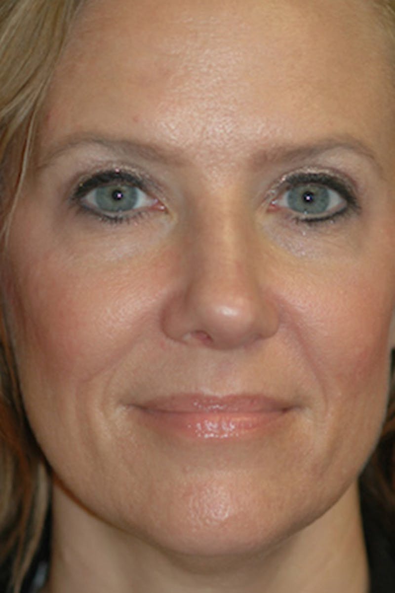 Rhinoplasty Before & After Gallery - Patient 175561 - Image 2