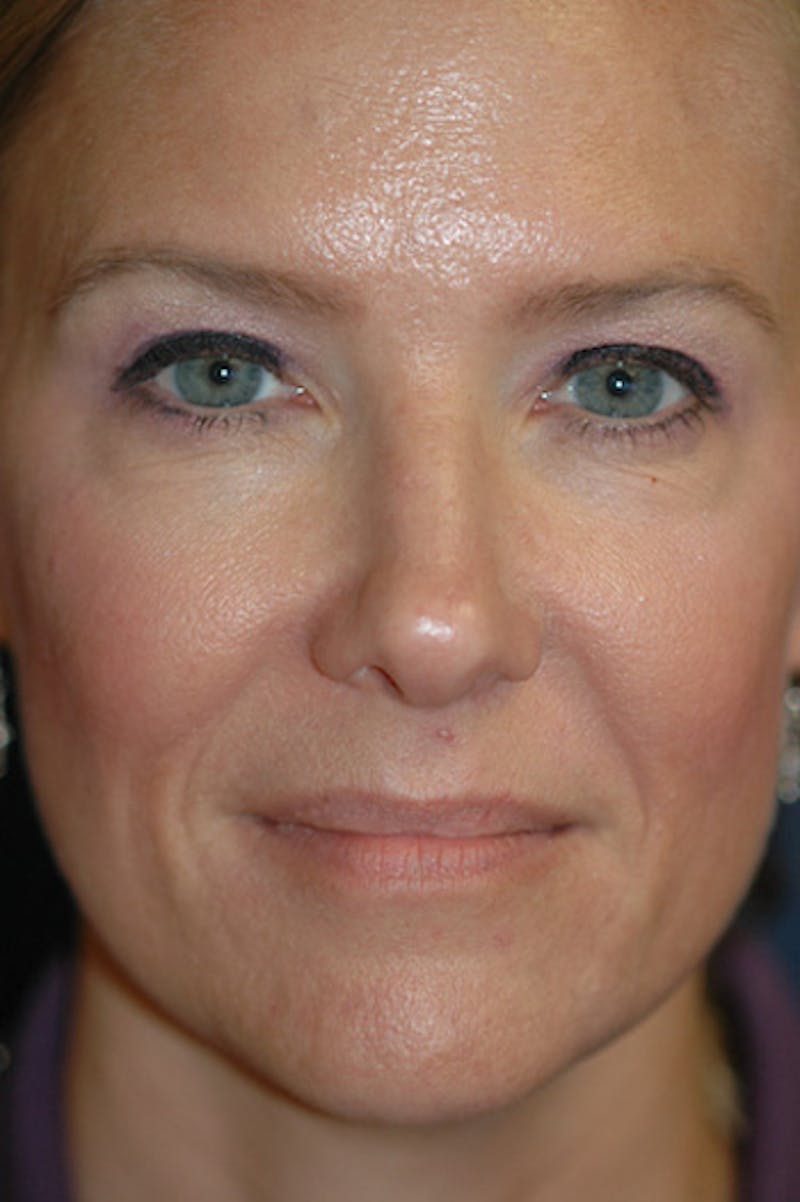 Rhinoplasty Before & After Gallery - Patient 175561 - Image 1