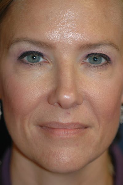 Rhinoplasty Before & After Gallery - Patient 175561 - Image 1