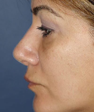 Rhinoplasty Before & After Gallery - Patient 115442 - Image 2
