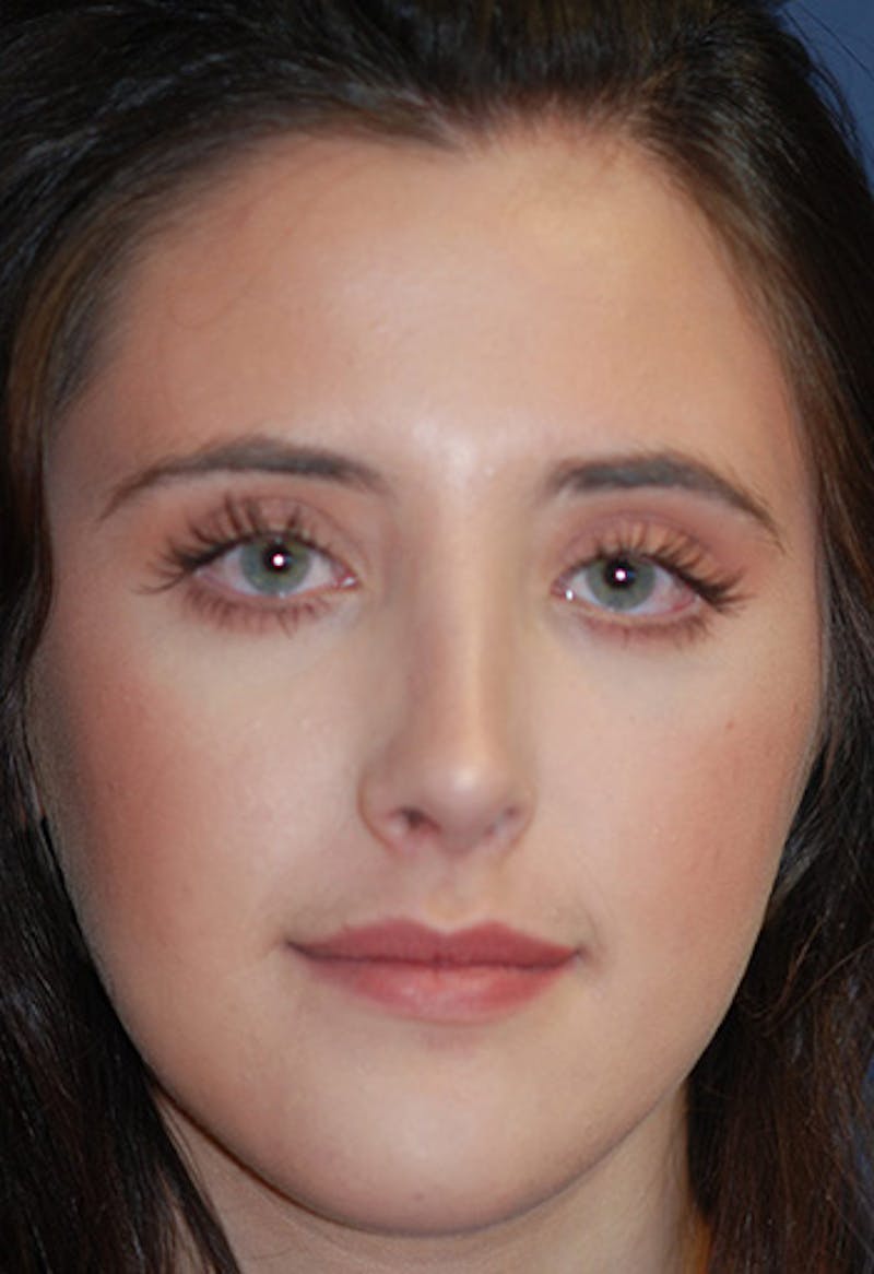 Rhinoplasty Before & After Gallery - Patient 265338 - Image 4