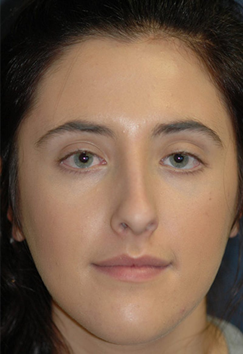 Rhinoplasty Before & After Gallery - Patient 265338 - Image 3