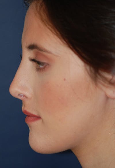 Rhinoplasty Before & After Gallery - Patient 265338 - Image 2