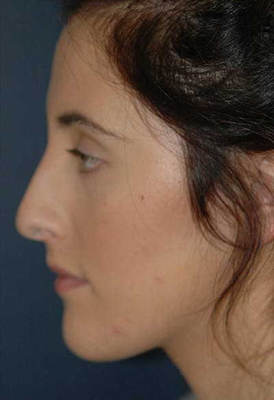 Rhinoplasty Before & After Gallery - Patient 265338 - Image 1