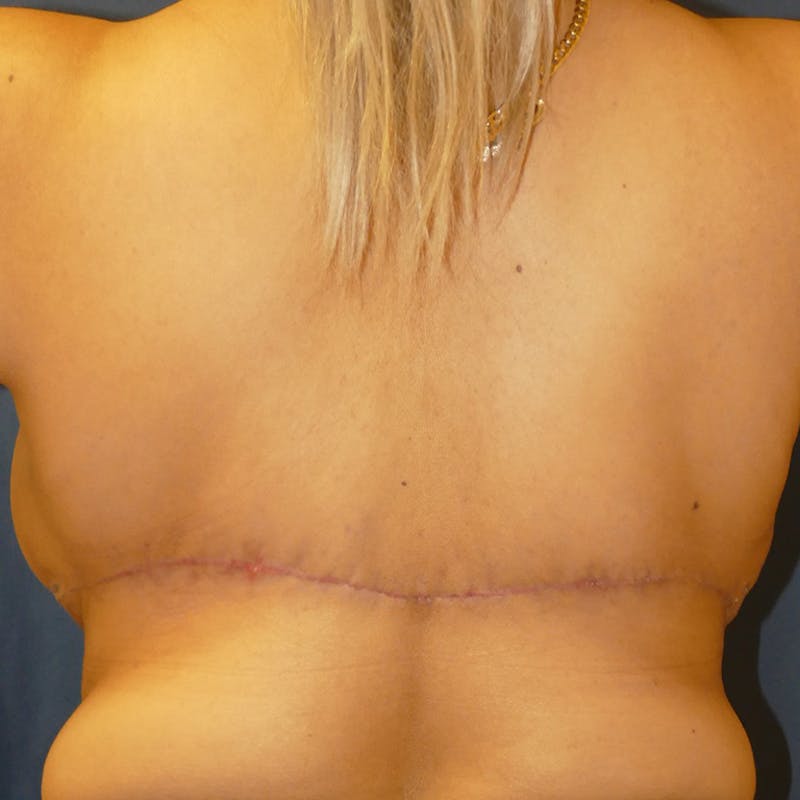 Breast Lift Before & After Gallery - Patient 115872 - Image 6