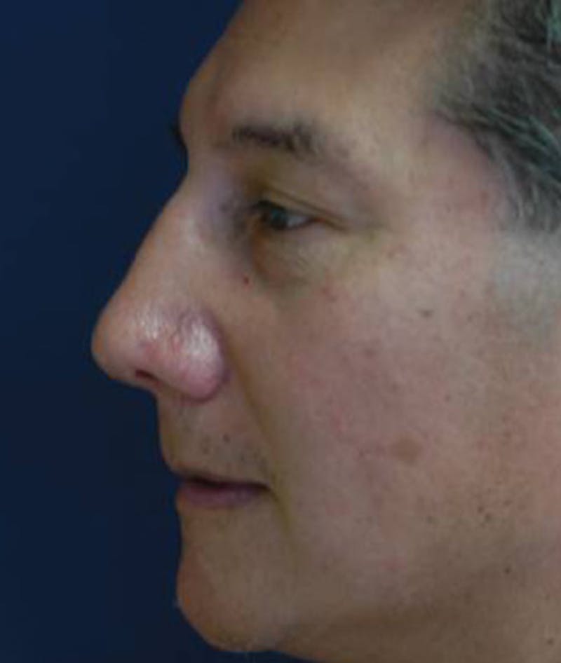 Rhinoplasty Before & After Gallery - Patient 223941 - Image 4