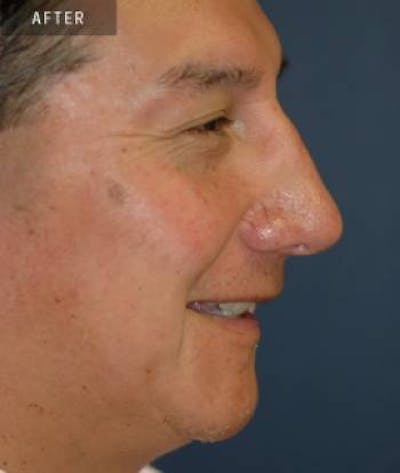 Rhinoplasty Before & After Gallery - Patient 223941 - Image 2