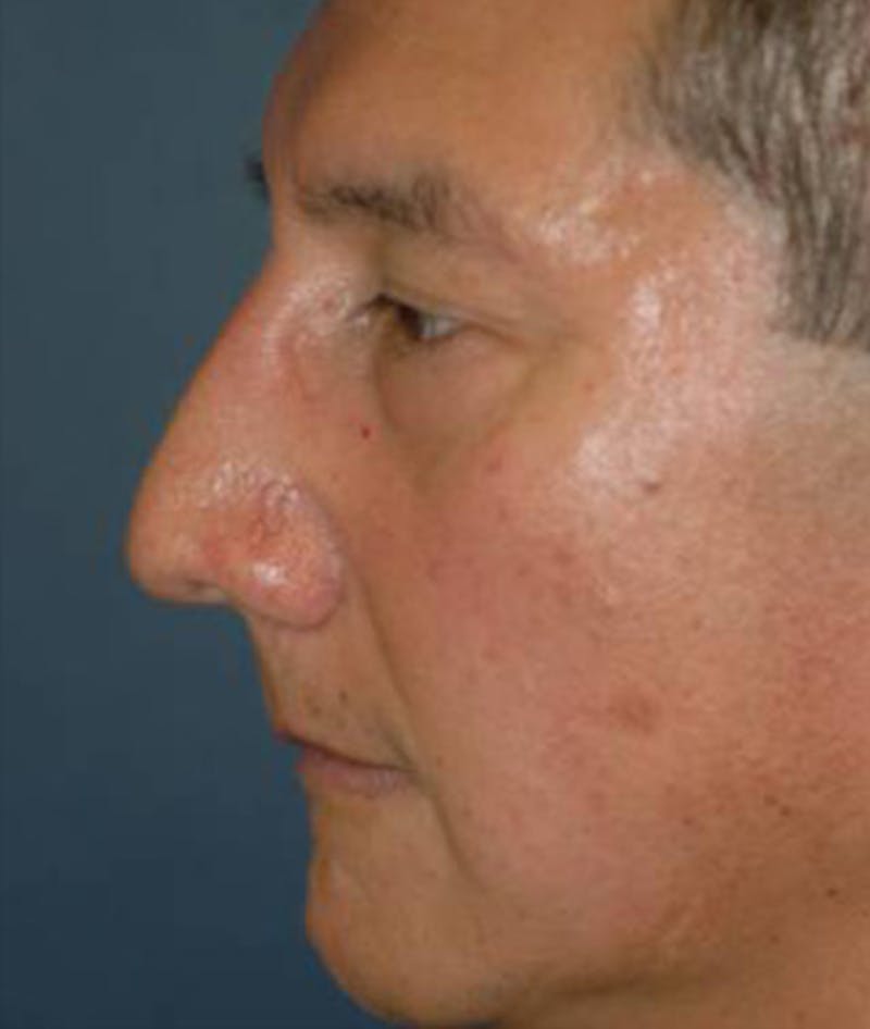 Rhinoplasty Before & After Gallery - Patient 223941 - Image 3