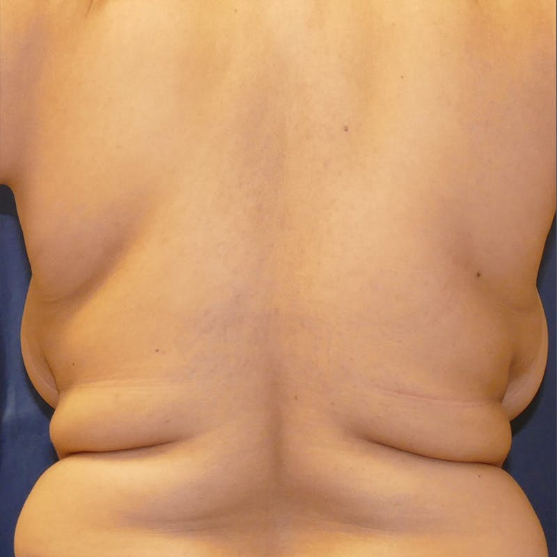 Breast Lift Before & After Gallery - Patient 115872 - Image 5