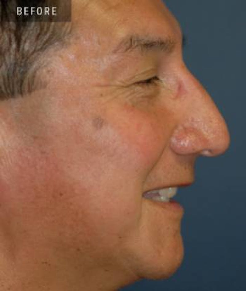 Rhinoplasty Before & After Gallery - Patient 223941 - Image 1