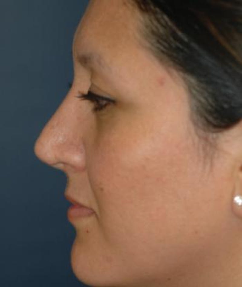Rhinoplasty Before & After Gallery - Patient 346949 - Image 6