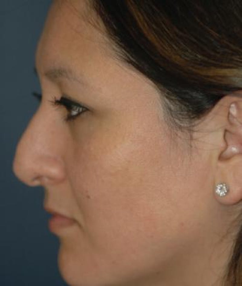 Rhinoplasty Before & After Gallery - Patient 346949 - Image 5