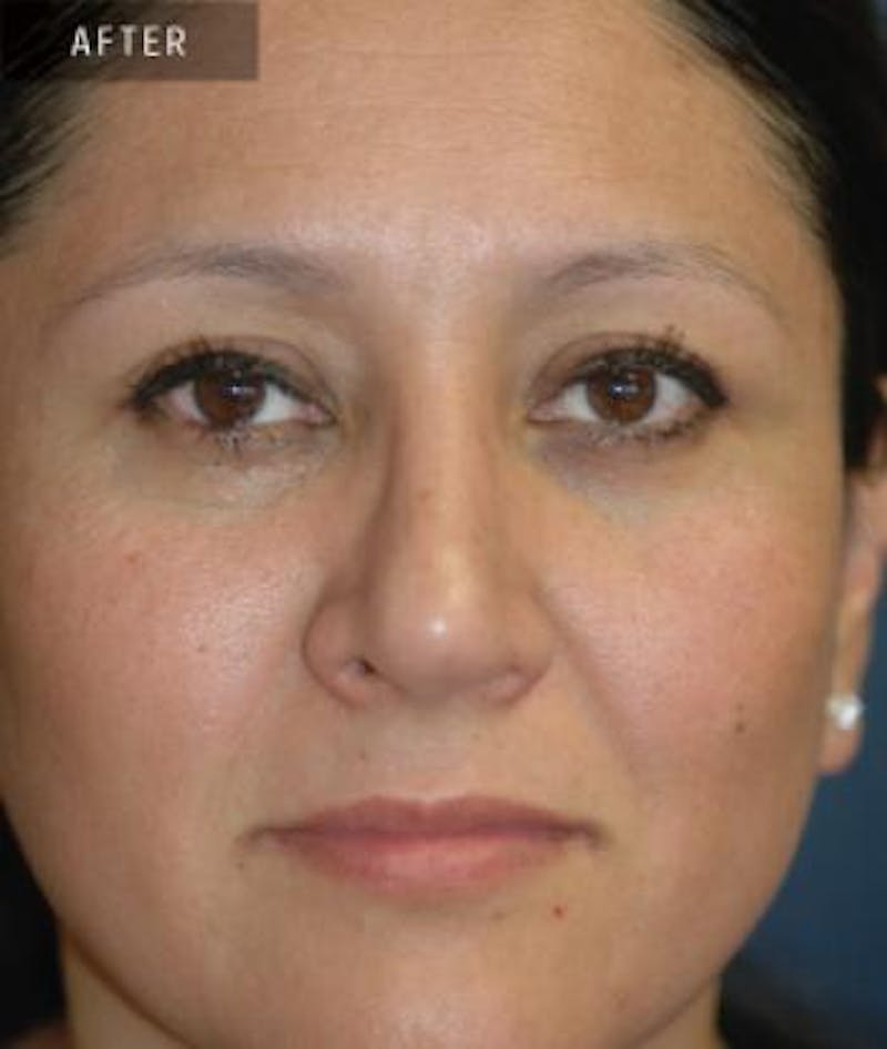 Rhinoplasty Before & After Gallery - Patient 346949 - Image 4