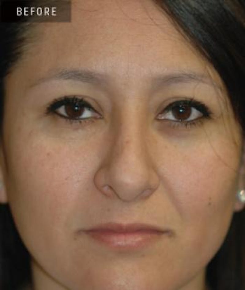 Rhinoplasty Before & After Gallery - Patient 346949 - Image 3