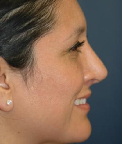 Rhinoplasty Before & After Gallery - Patient 346949 - Image 2