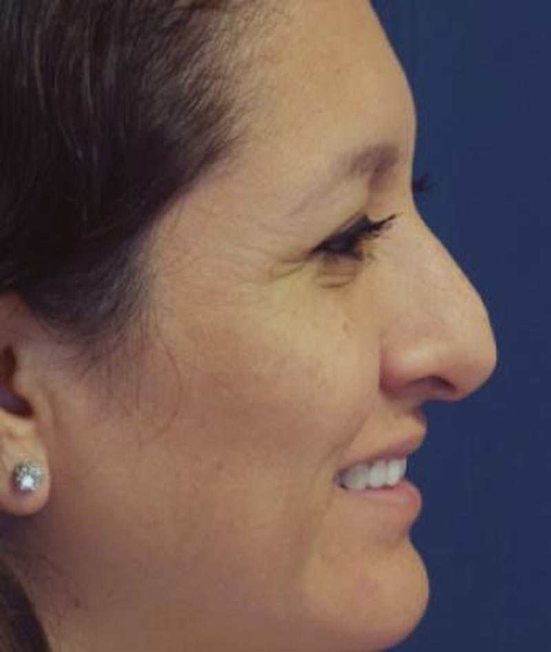 Rhinoplasty Before & After Gallery - Patient 346949 - Image 1