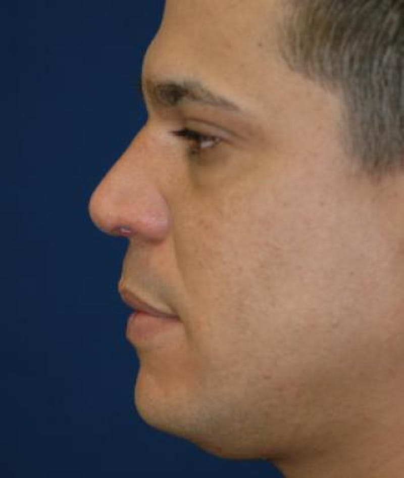 Rhinoplasty Before & After Gallery - Patient 286831 - Image 4