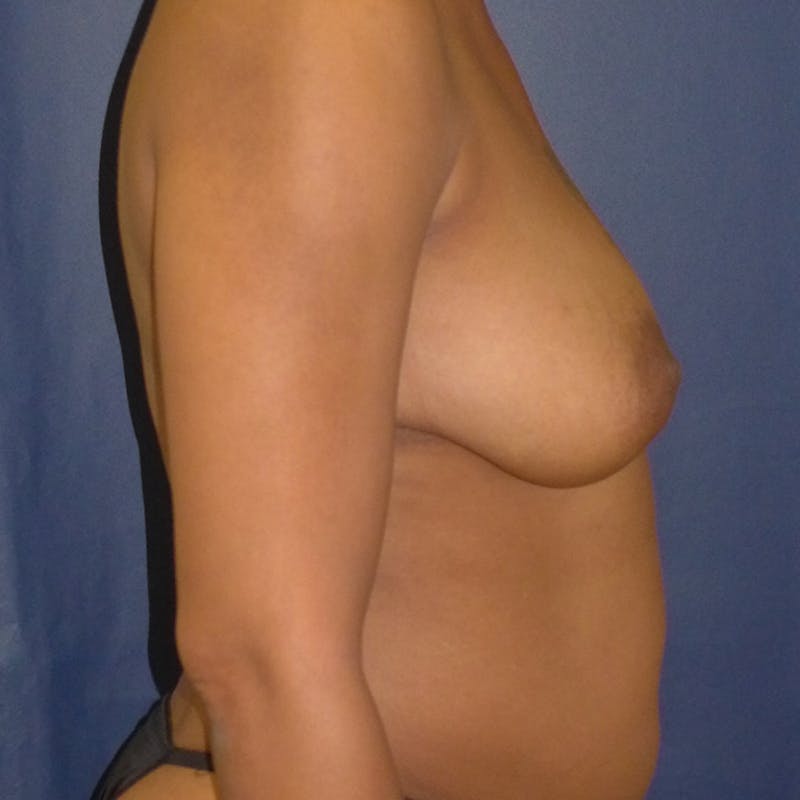 Breast Lift Before & After Gallery - Patient 260348 - Image 3