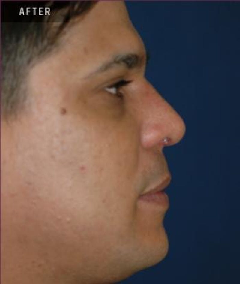 Rhinoplasty Before & After Gallery - Patient 286831 - Image 2