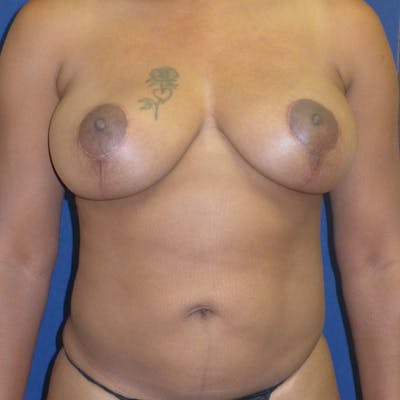 Breast Lift Before & After Gallery - Patient 260348 - Image 2