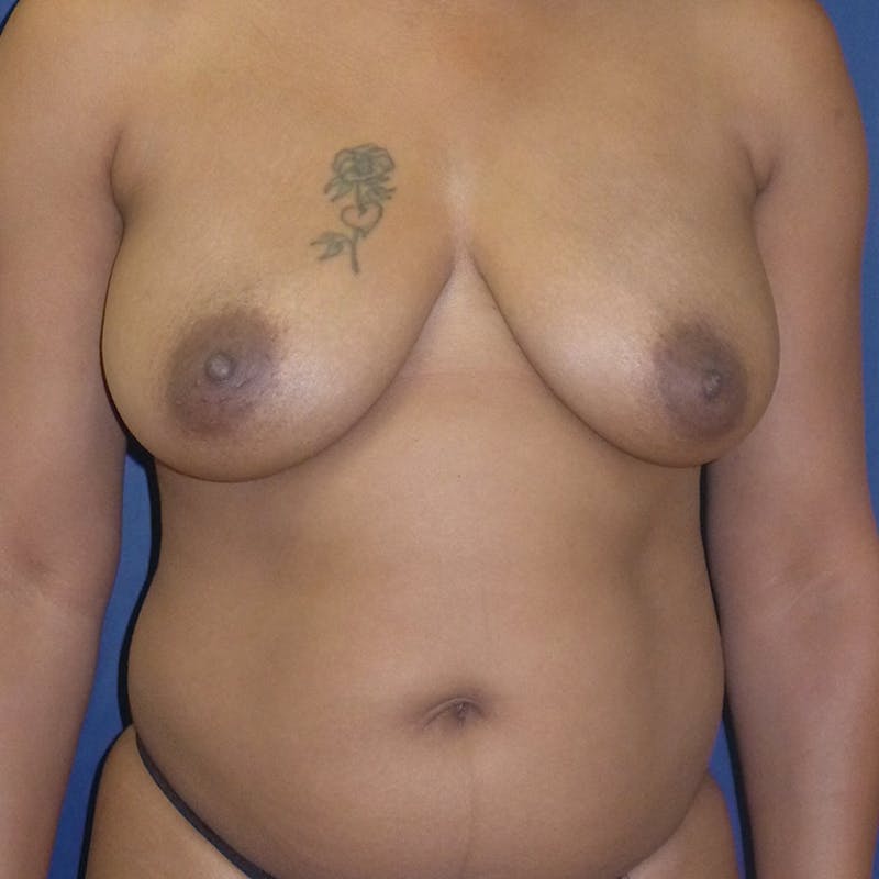 Breast Lift Before & After Gallery - Patient 260348 - Image 1