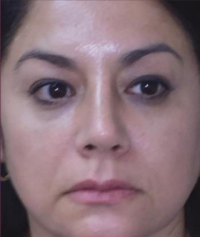 Rhinoplasty Before & After Gallery - Patient 279008 - Image 4