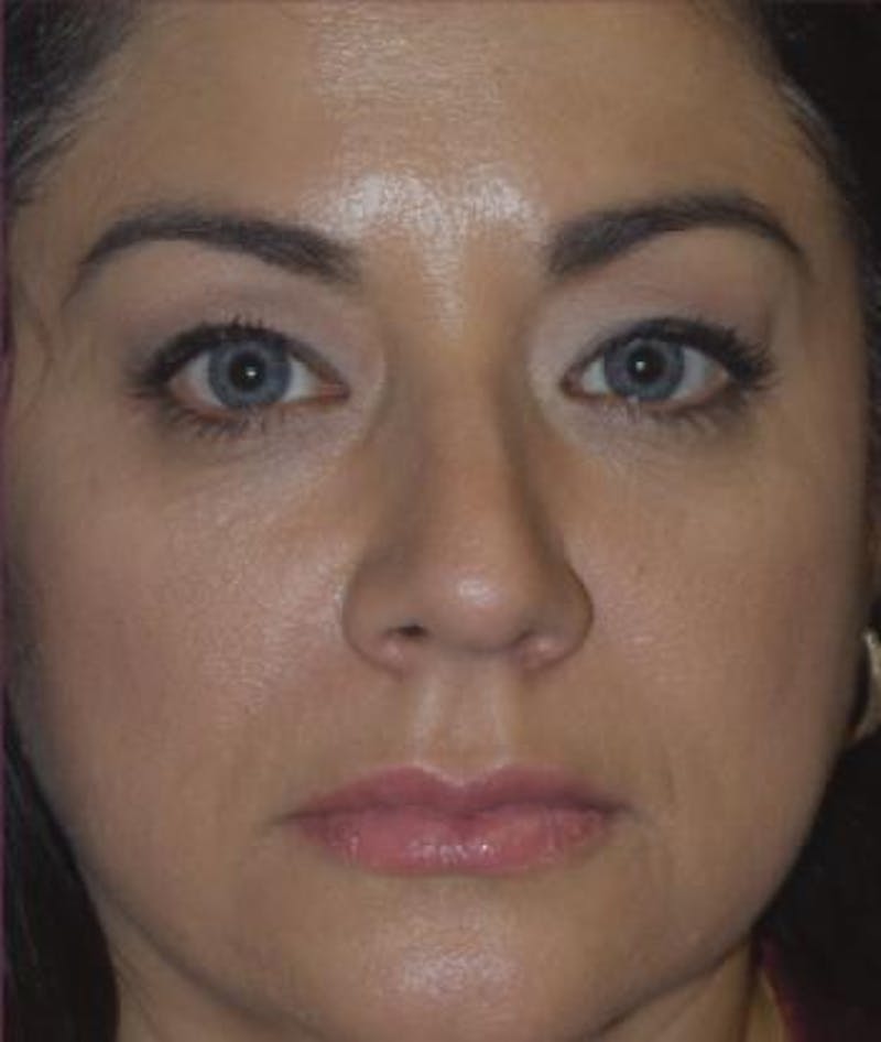 Rhinoplasty Before & After Gallery - Patient 279008 - Image 3