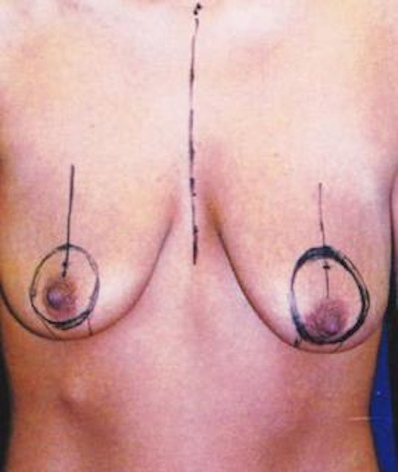 Breast Lift Before & After Gallery - Patient 332805 - Image 1