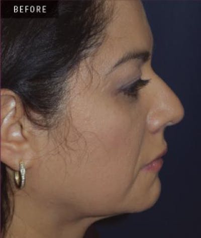 Rhinoplasty Before & After Gallery - Patient 279008 - Image 1