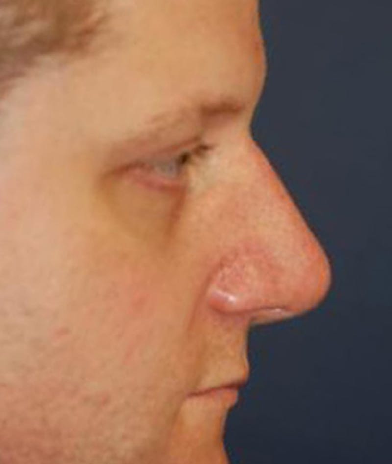 Rhinoplasty Before & After Gallery - Patient 139881 - Image 4
