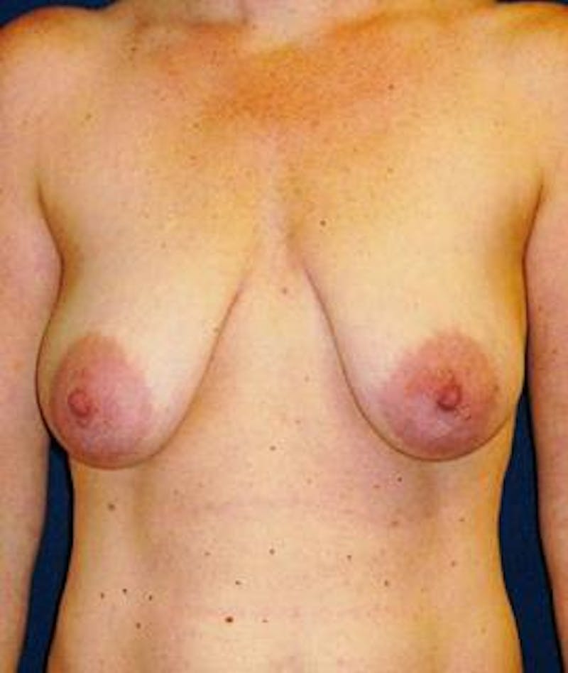 Breast Lift Before & After Gallery - Patient 289927 - Image 1
