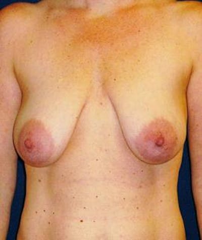 Breast Lift Before & After Gallery - Patient 289927 - Image 1