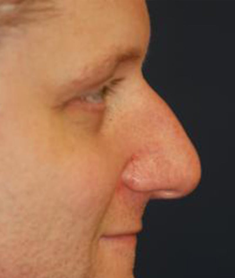 Rhinoplasty Before & After Gallery - Patient 139881 - Image 3