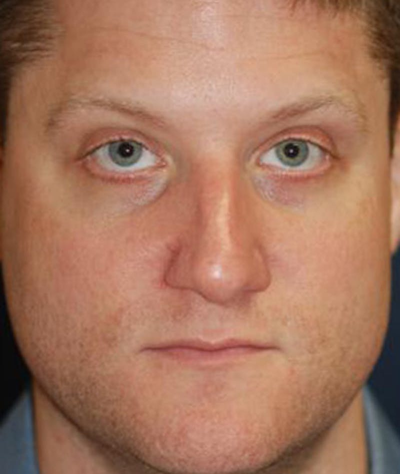Rhinoplasty Before & After Gallery - Patient 139881 - Image 2