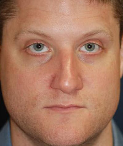 Rhinoplasty Before & After Gallery - Patient 139881 - Image 2