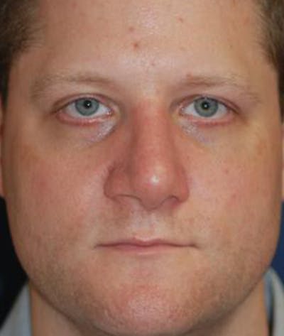Rhinoplasty Before & After Gallery - Patient 139881 - Image 1