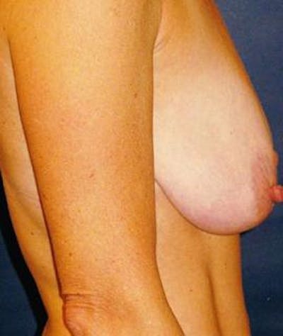 Breast Lift Before & After Gallery - Patient 273674 - Image 1