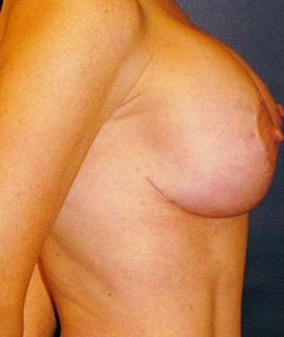 Breast Lift Before & After Gallery - Patient 273674 - Image 2