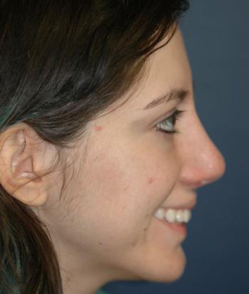 Rhinoplasty Before & After Gallery - Patient 165912 - Image 6