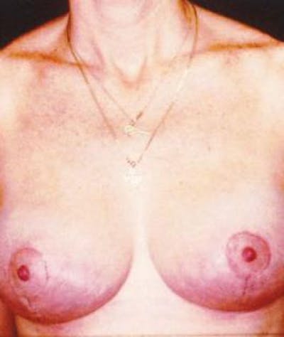 Breast Lift Before & After Gallery - Patient 125564 - Image 2