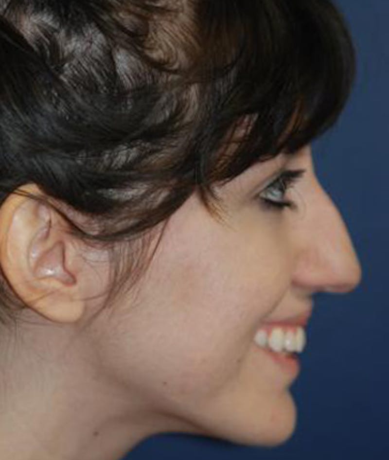 Rhinoplasty Before & After Gallery - Patient 165912 - Image 5