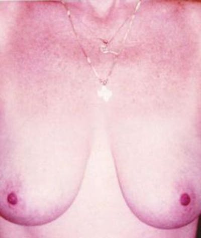 Breast Lift Before & After Gallery - Patient 125564 - Image 1