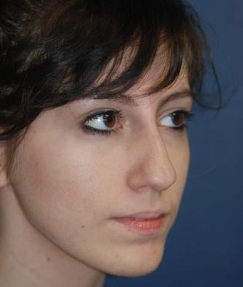 Rhinoplasty Before & After Gallery - Patient 165912 - Image 3