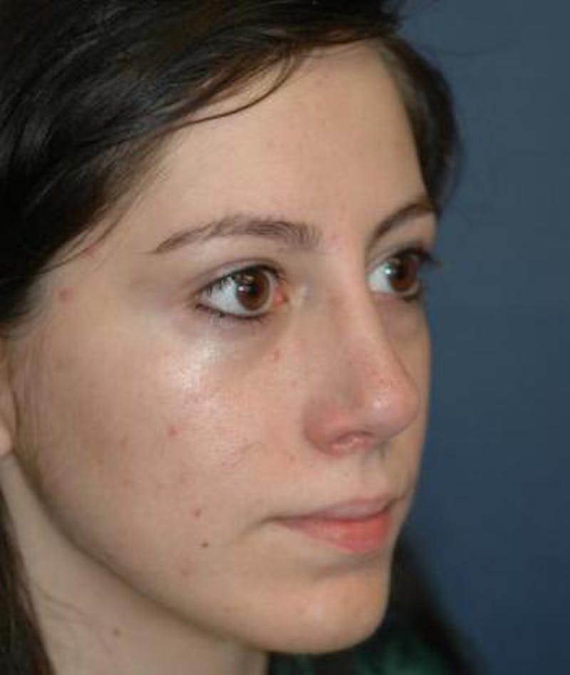 Rhinoplasty Before & After Gallery - Patient 165912 - Image 4